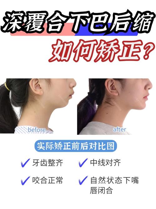 正畸快结束为何需再治疗深覆颌?-图1 正畸快结束为何需再治疗深覆颌?-图1