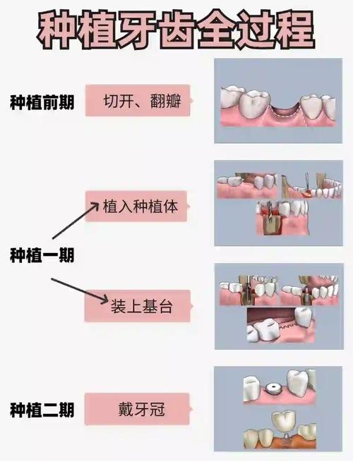 美国3i植体系统种牙靠谱吗?优势、寿命及适用人群如何?-图2 美国3i植体系统种牙靠谱吗?优势、寿命及适用人群如何?-图2