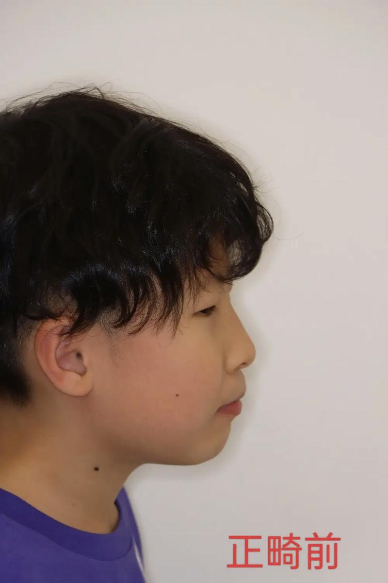 戴正畸头帽期间，还能正常吃东西吗？-图3