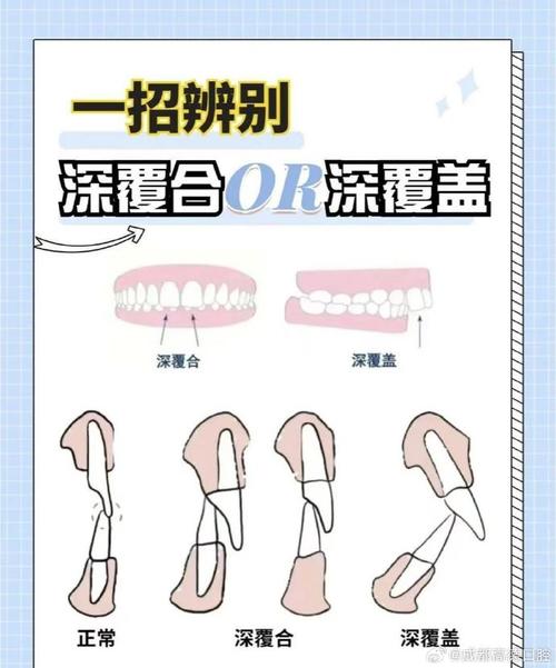 活动牙垂直距离确定方法有哪些?如何精准选择?-图2 活动牙垂直距离确定方法有哪些?如何精准选择?-图2