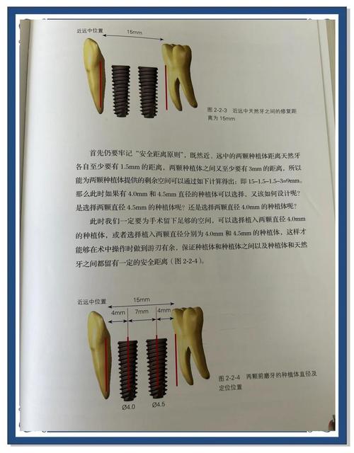 活动牙垂直距离确定方法有哪些?如何精准选择?-图1 活动牙垂直距离确定方法有哪些?如何精准选择?-图1