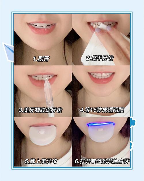 医院美白牙齿的最快方法-图2 医院美白牙齿的最快方法-图2