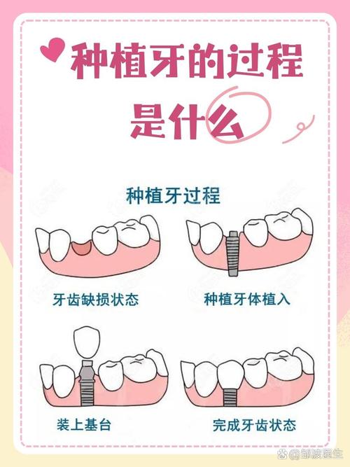 口腔种植价值塑造的方法-图2