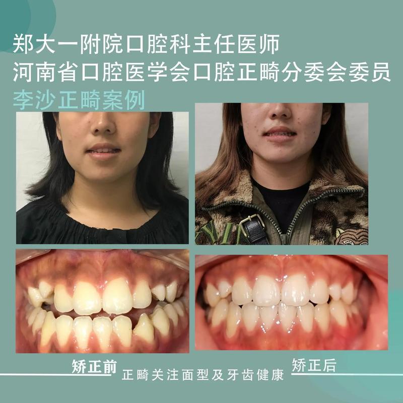郑州牙齿正畸好的医院怎么选?求推荐靠谱正规的医院!-图3 郑州牙齿正畸好的医院怎么选?求推荐靠谱正规的医院!-图3