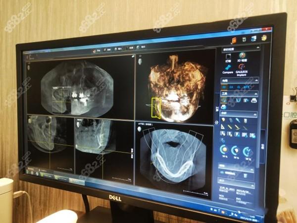 数字化种牙哪家医院能做？求靠谱推荐-图1