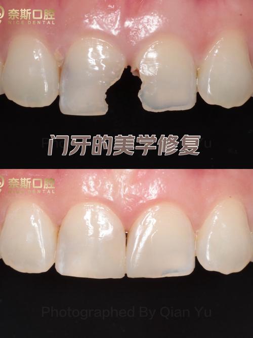 门牙修补后还能做正畸吗？-图1