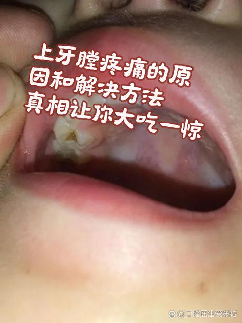 种牙碰到上颌窦说话疼是什么原因？该如何处理？-图1