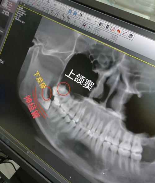 种牙碰到上颌窦说话疼是什么原因？该如何处理？-图2