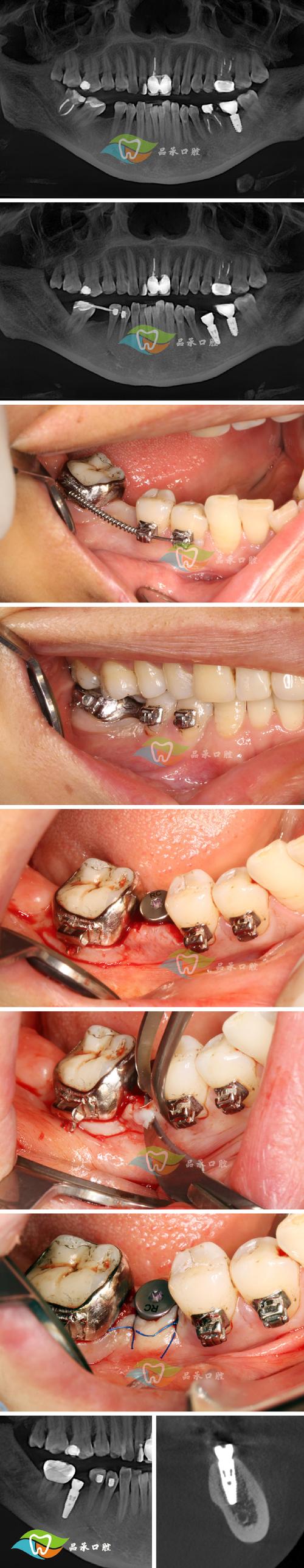 拜博口腔急拔急种牙可行吗?安全效果如何?-图2 拜博口腔急拔急种牙可行吗?安全效果如何?-图2