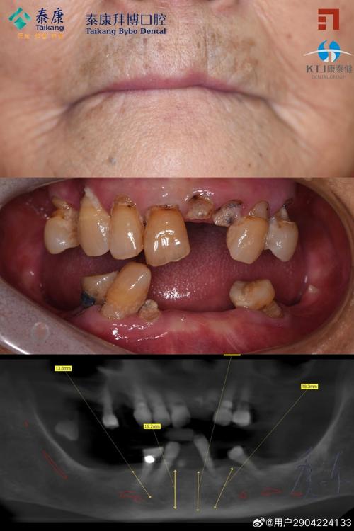 拜博口腔急拔急种牙可行吗?安全效果如何?-图1 拜博口腔急拔急种牙可行吗?安全效果如何?-图1