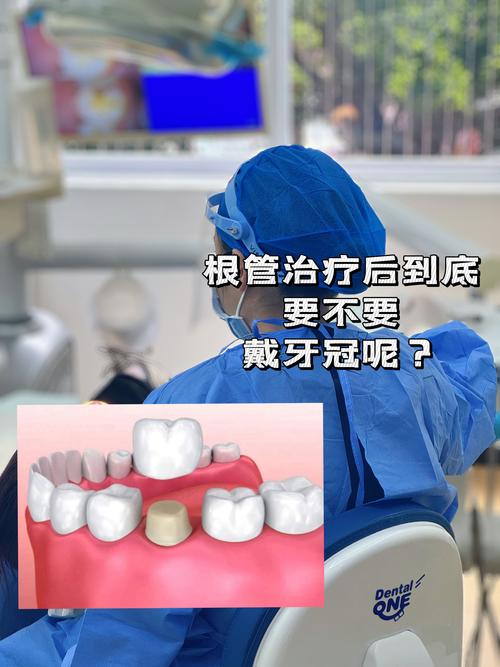 种牙与根管治疗后，牙套选择有何不同？如何选？-图2