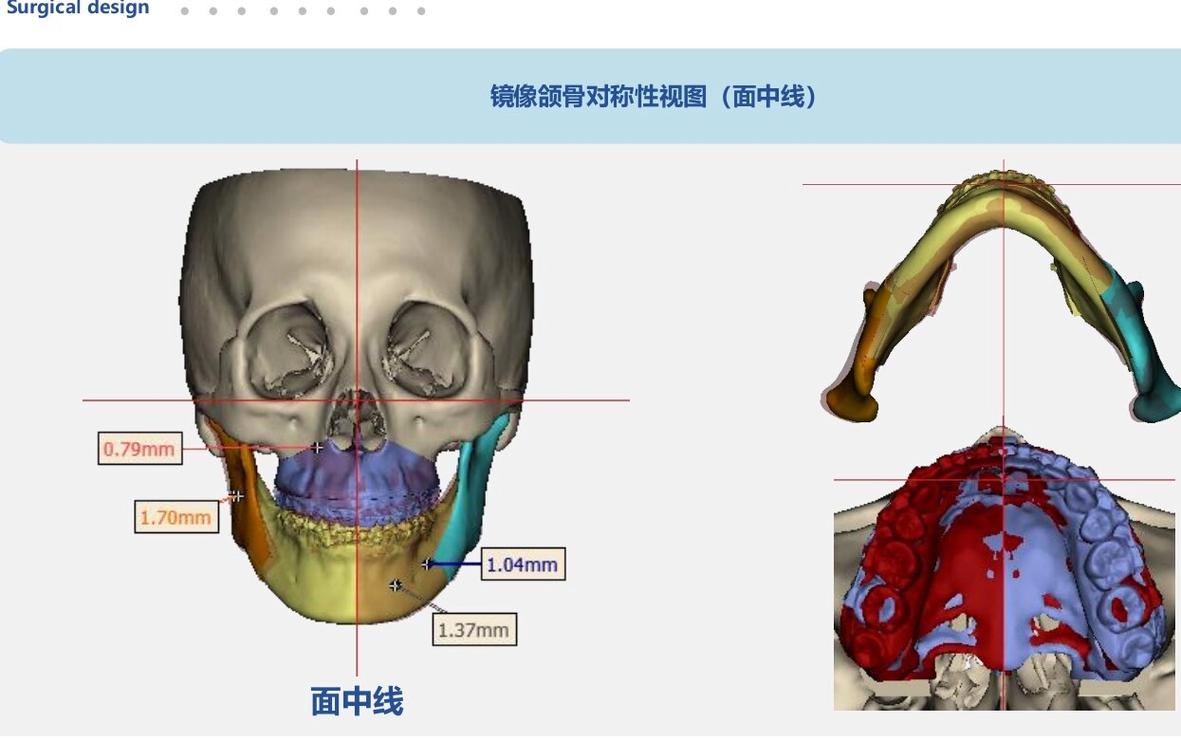 二类错合畸形手术方法-图2