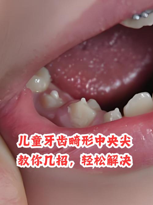 尖牙牙根突出可以进行正畸矫正吗？-图2