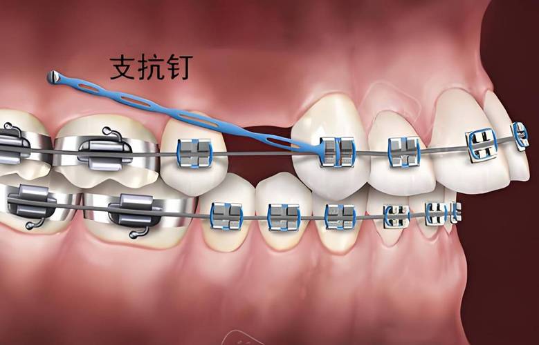 正畸支抗钉怎么取下来?过程疼吗?操作复杂吗?-图1 正畸支抗钉怎么取下来?过程疼吗?操作复杂吗?-图1