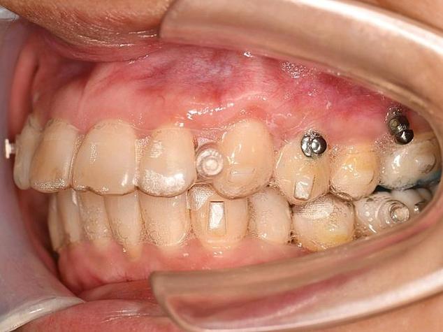 正畸支抗钉怎么取下来?过程疼吗?操作复杂吗?-图2 正畸支抗钉怎么取下来?过程疼吗?操作复杂吗?-图2