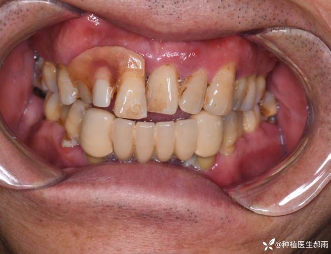 正畸期间带环的牙松动是什么原因导致的?-图2 正畸期间带环的牙松动是什么原因导致的?-图2