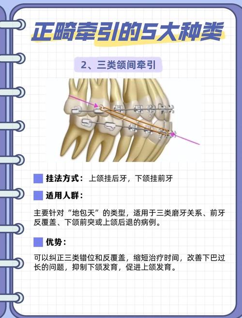 前方牵引会有间隙吗正畸-图3 前方牵引会有间隙吗正畸-图3