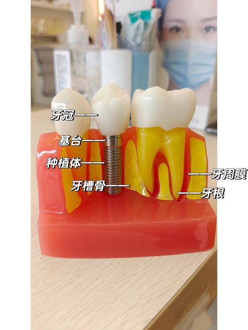 连续缺失三颗门牙种牙可行吗？如何修复？-图3