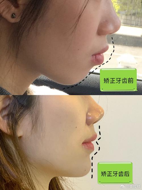 骨性龅牙正畸能治好吗?矫正效果如何?-图1 骨性龅牙正畸能治好吗?矫正效果如何?-图1