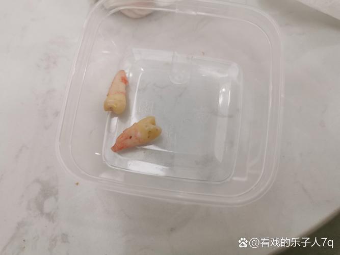 门牙两个拔掉 待种牙-图3 门牙两个拔掉 待种牙-图3