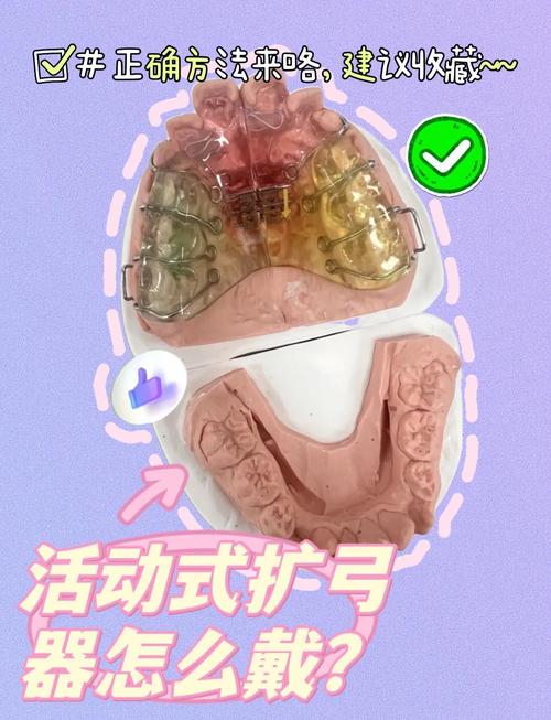 上颌扩弓器怎么用?正确步骤及注意事项有哪些-图1 上颌扩弓器怎么用?正确步骤及注意事项有哪些-图1