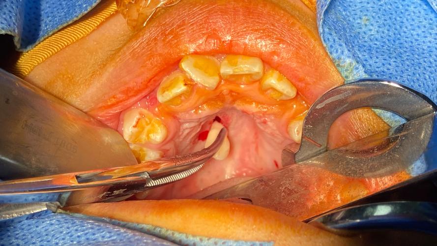 微创多生牙拔除,不同方法的选择与操作技巧是什么?-图2 微创多生牙拔除,不同方法的选择与操作技巧是什么?-图2