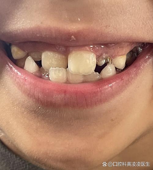正畸会让牙齿晃动吗?牙齿移动的疑问解答-图2 正畸会让牙齿晃动吗?牙齿移动的疑问解答-图2