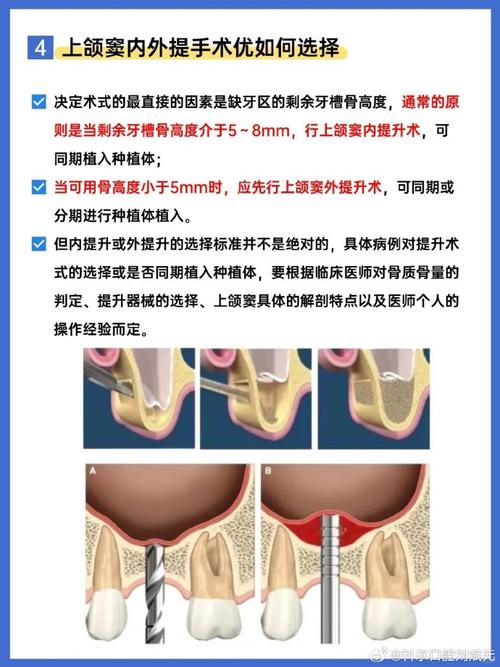 什么是种牙上颌窦提升?-图2 什么是种牙上颌窦提升?-图2