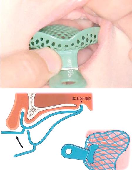 如何正确取闭口印模?方法视频演示关键步骤-图1 如何正确取闭口印模?方法视频演示关键步骤-图1