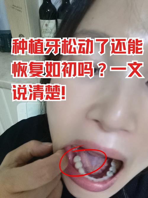 牙龈缺失严重还能种牙吗?可行性与条件是什么?-图1 牙龈缺失严重还能种牙吗?可行性与条件是什么?-图1