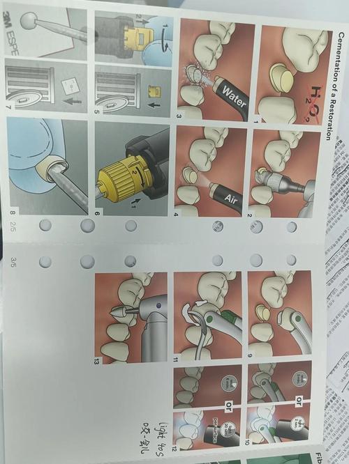 如何正确掌握纤维根管桩的使用方法与步骤?-图1 如何正确掌握纤维根管桩的使用方法与步骤?-图1