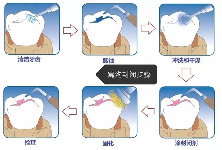 窝沟封闭剂的使用方法-图2 窝沟封闭剂的使用方法-图2