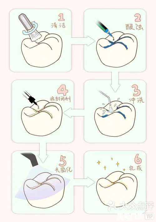 窝沟封闭剂的使用方法-图1 窝沟封闭剂的使用方法-图1