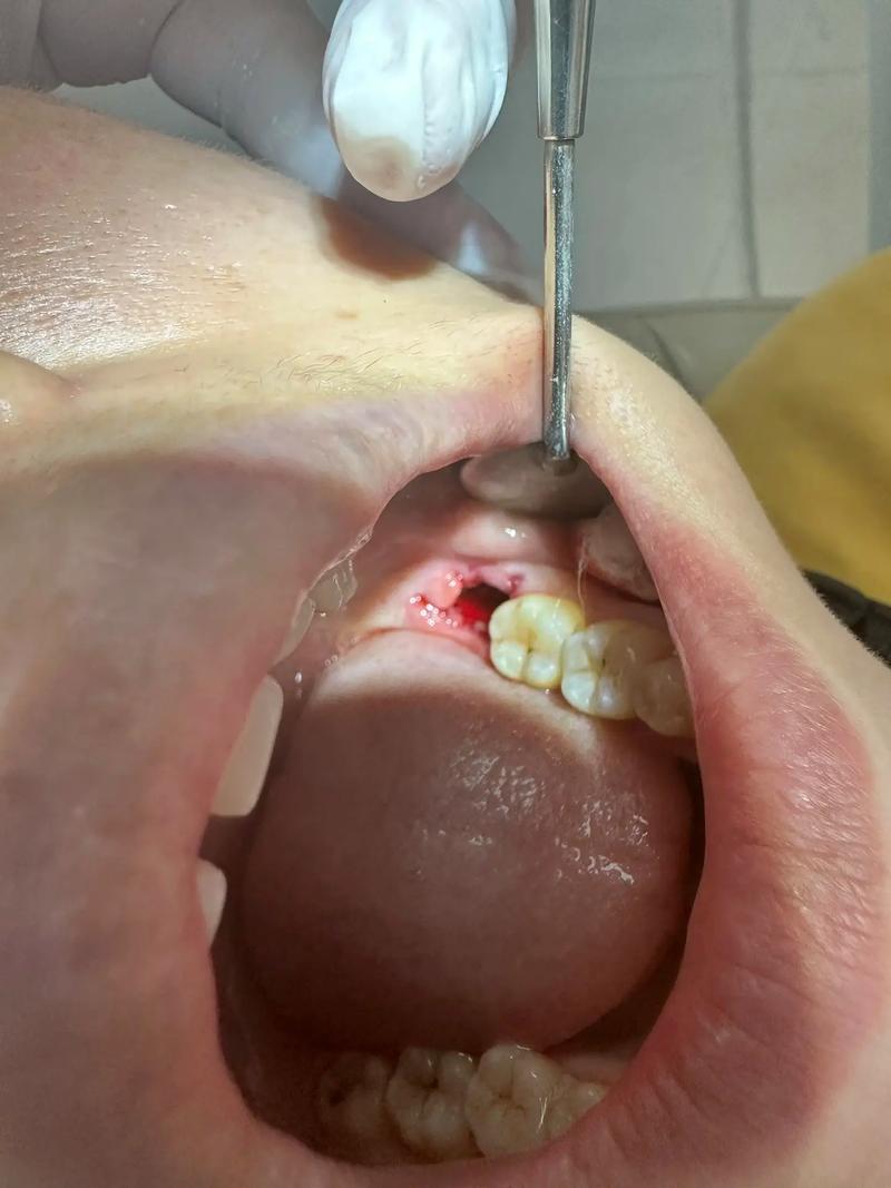 永川拜博口腔拔智齿疼不疼?价格贵吗效果如何?-图2 永川拜博口腔拔智齿疼不疼?价格贵吗效果如何?-图2