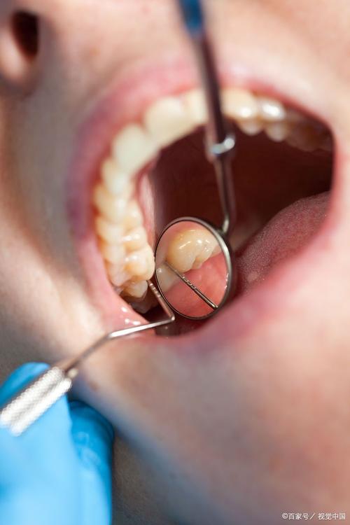永川拜博口腔拔智齿疼不疼?价格贵吗效果如何?-图3 永川拜博口腔拔智齿疼不疼?价格贵吗效果如何?-图3