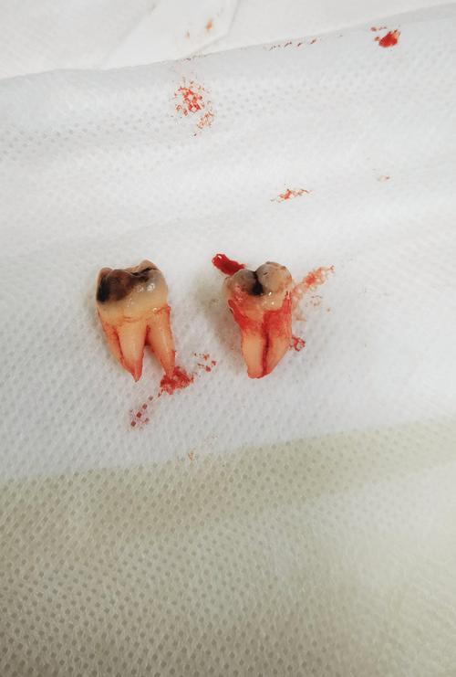 永川拜博口腔拔智齿疼不疼?价格贵吗效果如何?-图1 永川拜博口腔拔智齿疼不疼?价格贵吗效果如何?-图1