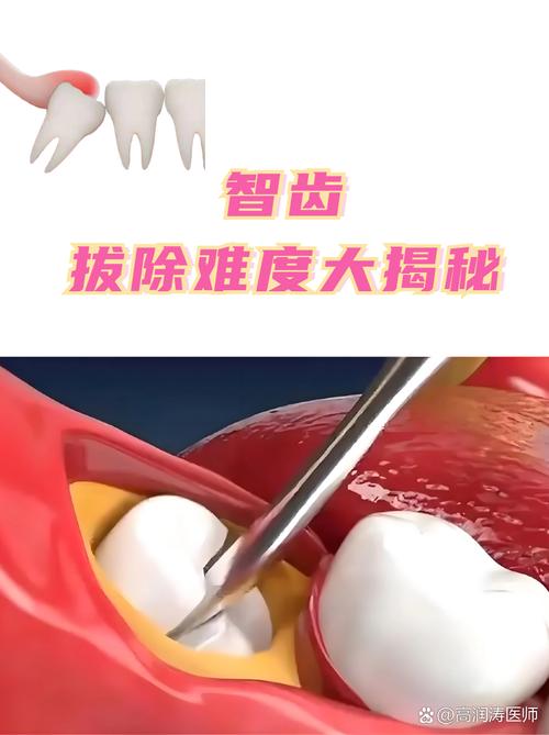 近中阻生齿拔牙有哪些关键方法？如何操作？-图3