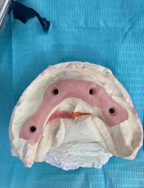 曾经戴过假牙的人，现在还能种牙吗？-图1