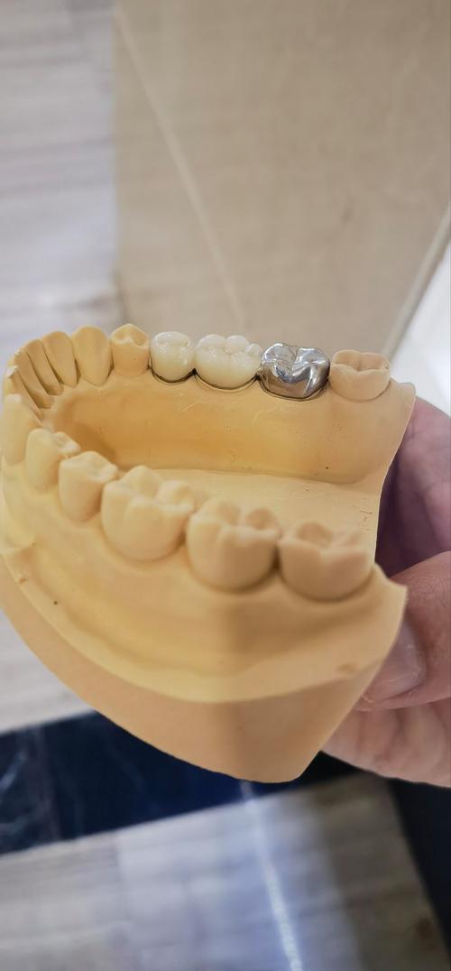 种牙后牙冠有点松动是什么原因?需要立即处理吗?-图1 种牙后牙冠有点松动是什么原因?需要立即处理吗?-图1