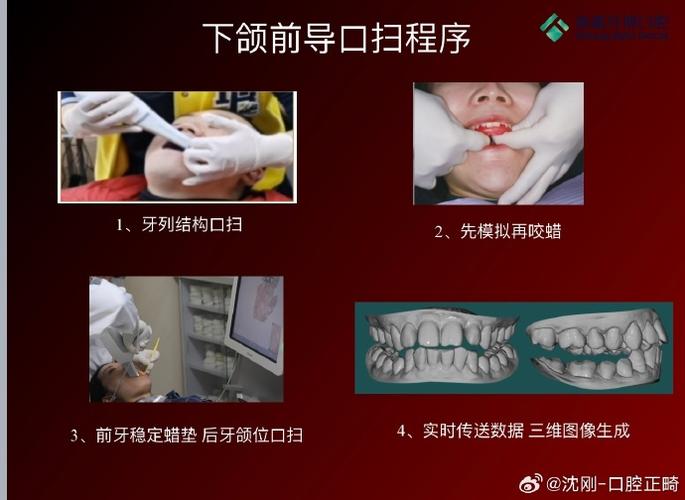 上颌后提区的制作方法应如何规范操作?关键步骤有哪些?-图1 上颌后提区的制作方法应如何规范操作?关键步骤有哪些?-图1