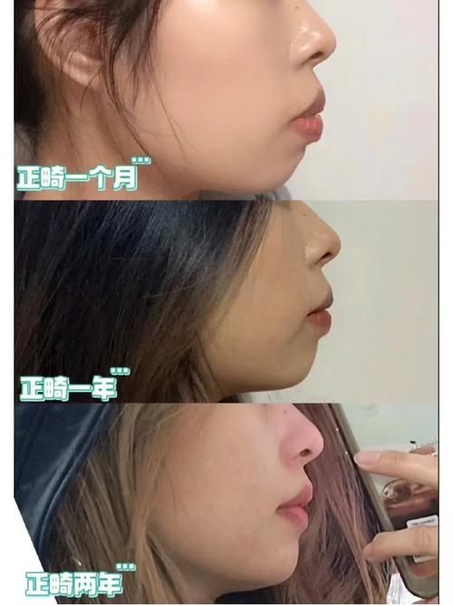 正畸内收多少量能有效改变面型？-图2