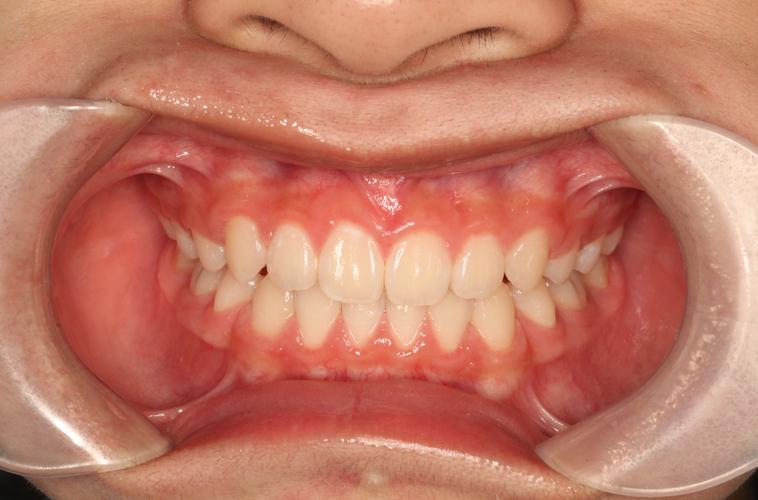 标准舌侧正畸弓形图下载渠道有哪些?-图2 标准舌侧正畸弓形图下载渠道有哪些?-图2