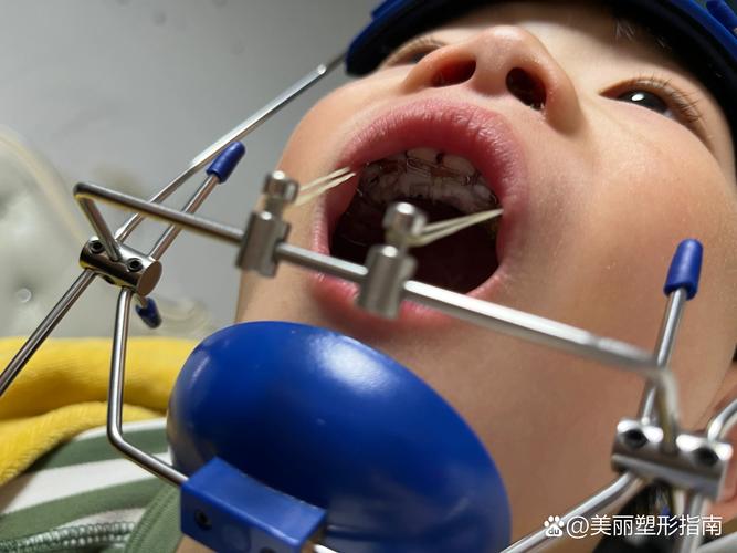 杭州拜博口腔地包天-图1 杭州拜博口腔地包天-图1