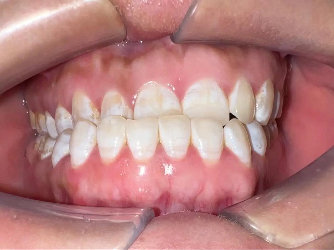 杭州拜博口腔地包天-图2 杭州拜博口腔地包天-图2