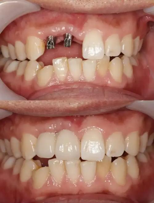 种牙好还是固定假牙好？优缺点对比如何选？-图2