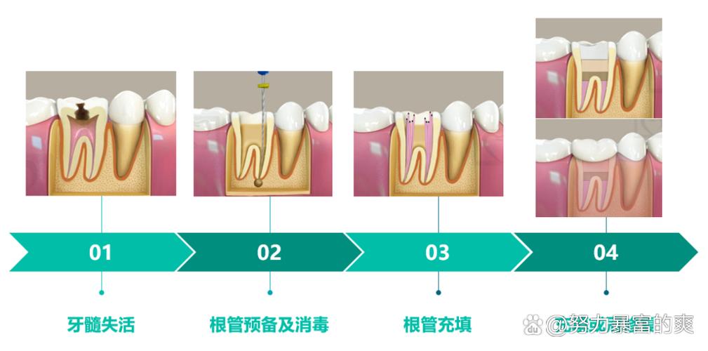 根管消毒的方法有哪些-图2 根管消毒的方法有哪些-图2