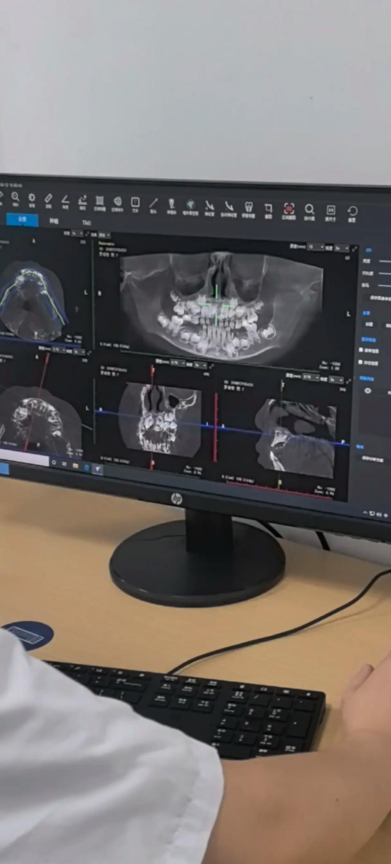 拜博口腔超声刀拔牙优势有哪些?-图3 拜博口腔超声刀拔牙优势有哪些?-图3