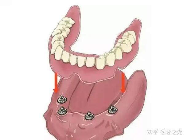 龈合距离多少可以种牙?种植成功的龈合距离最低要求是多少?-图2 龈合距离多少可以种牙?种植成功的龈合距离最低要求是多少?-图2