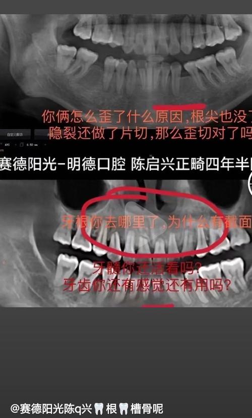 正畸过程中牙齿断了,该怎么办?-图1 正畸过程中牙齿断了,该怎么办?-图1