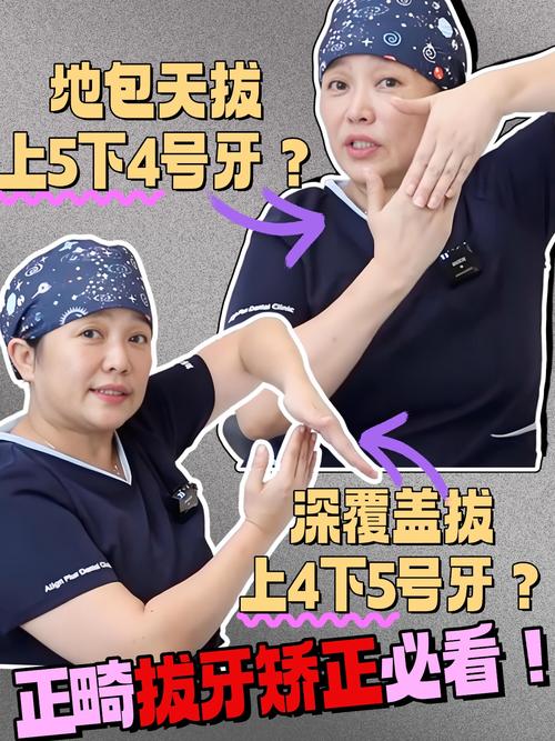 正畸拔4颗和5颗牙区别在哪?-图3 正畸拔4颗和5颗牙区别在哪?-图3